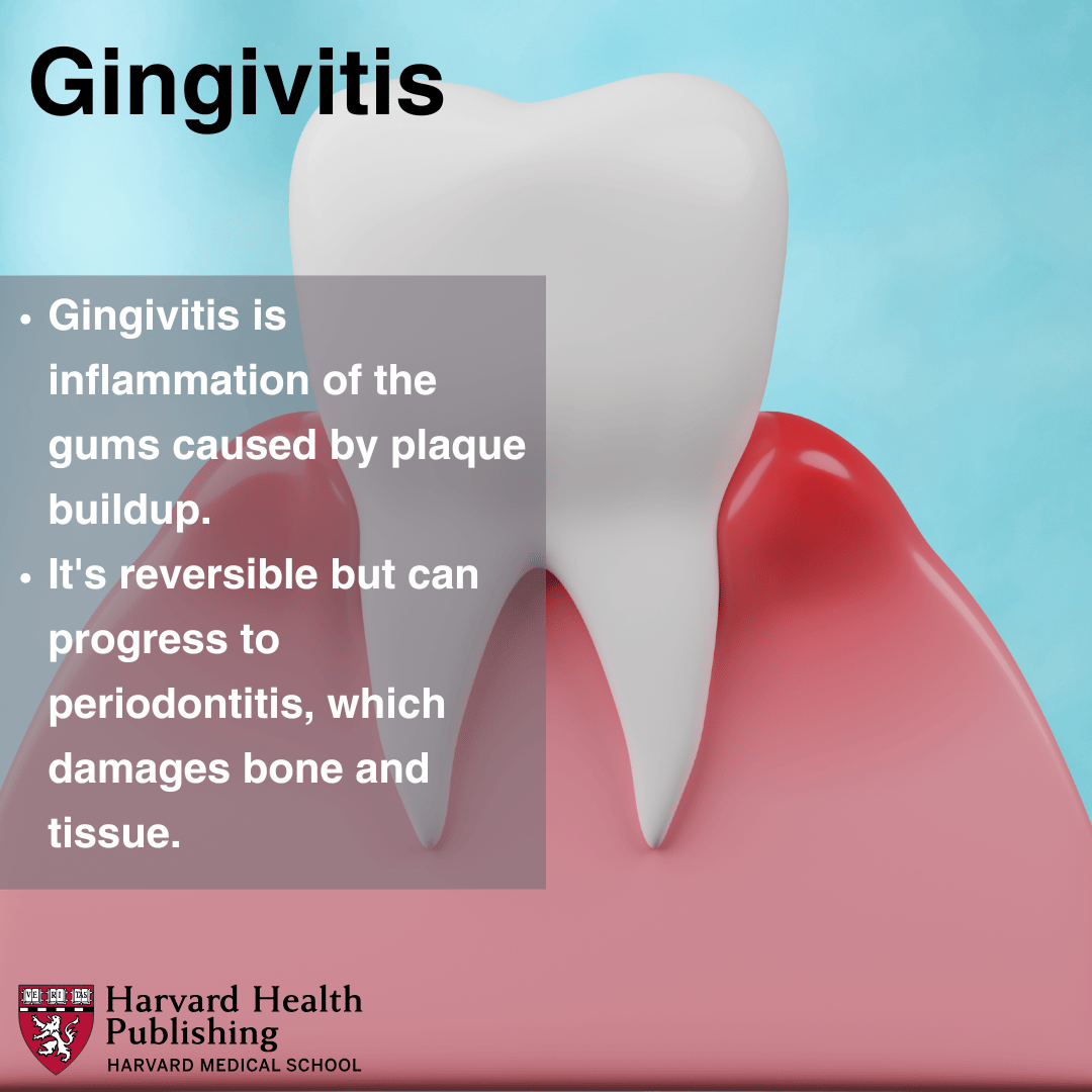 Tooth and sore gums with text explaining what gingivitis is